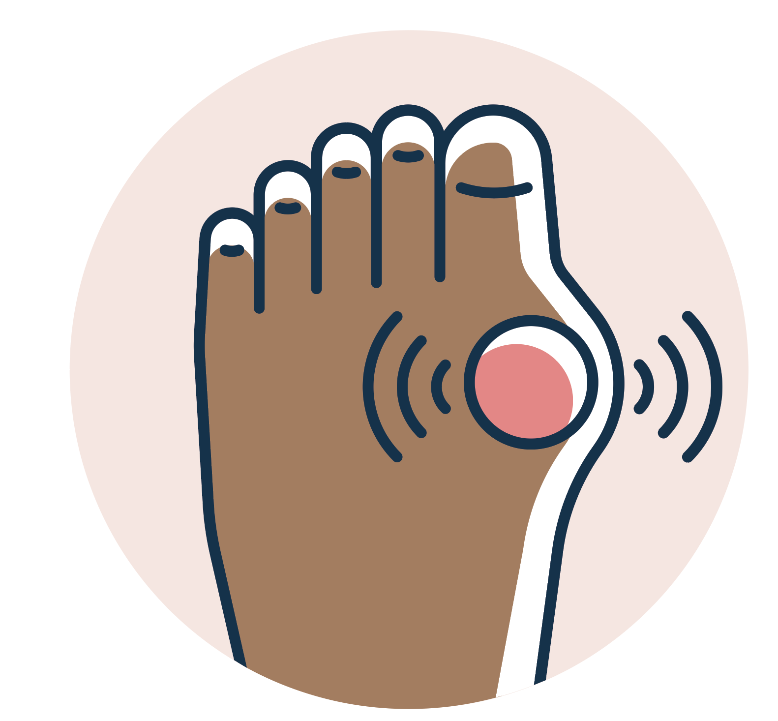 An illustration of a foot with a gout flare up.