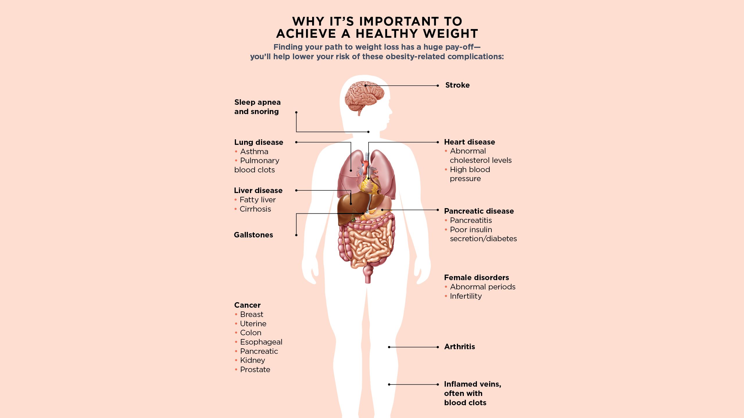 An illustration of human organs and disease descriptions. (Sleep apnea, lung disease, liver disease, gallstones, stroke, heart disease pancreatic disease.) 