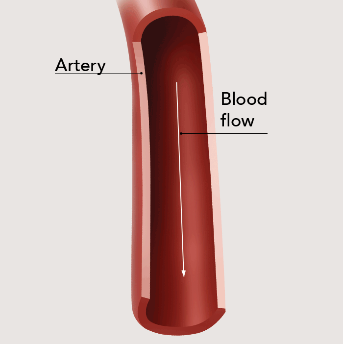 An illustration of plaque buildup in the artery; is the flow of blood being constricted within an artery.