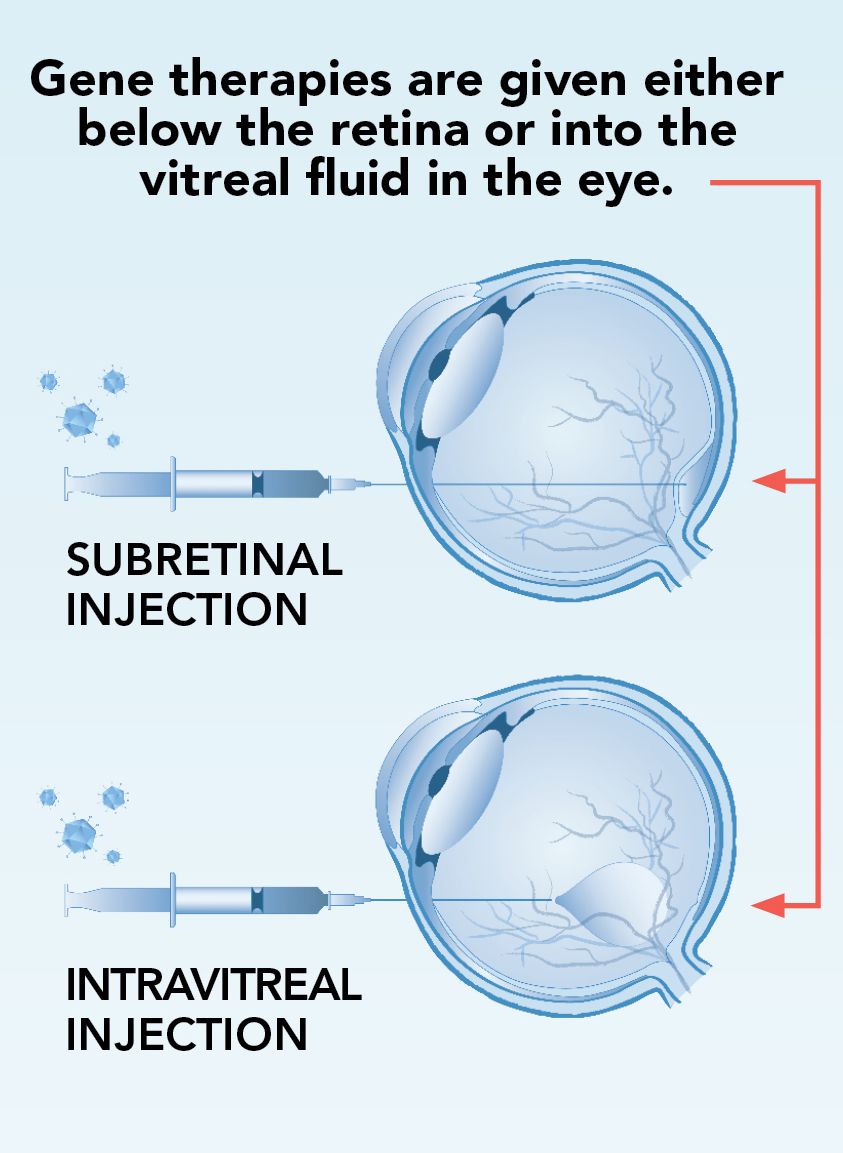 Gene therapies are given either below the retina or into the vitreal fluid in the eye.