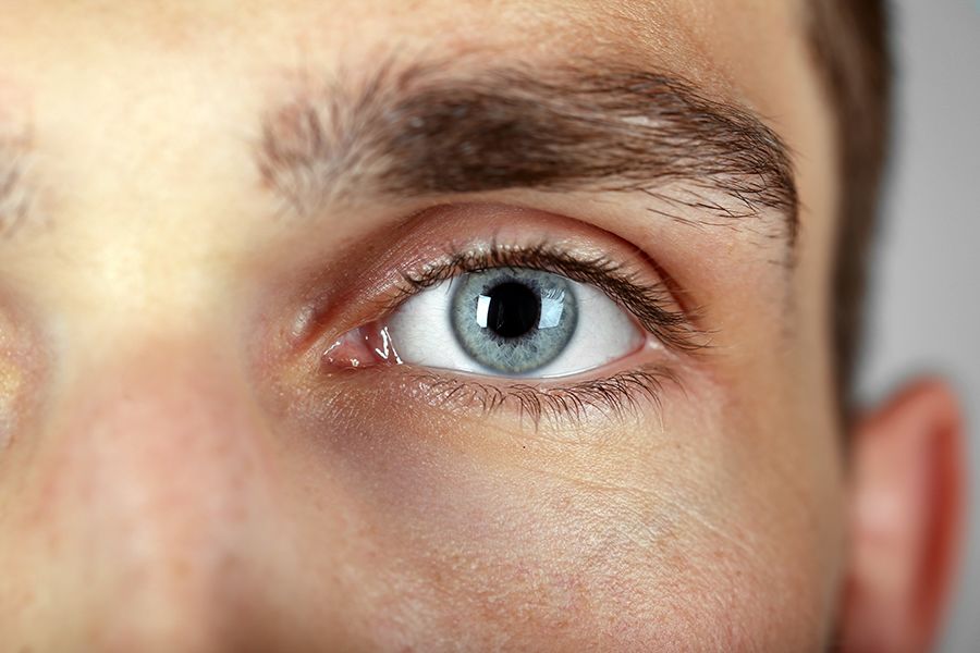 An image of a man with graves disease eye.